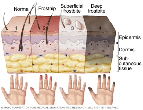 Infographic showing different levels of frost bite